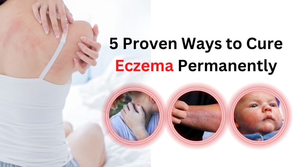 How to Cure Eczema permanently